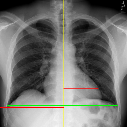 Chest X-ray analysis output